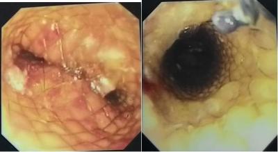 Figure 1: Giant bariatric stent